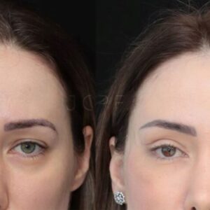 Os Principais Tipos de Lifting Facial e Como Funcionam