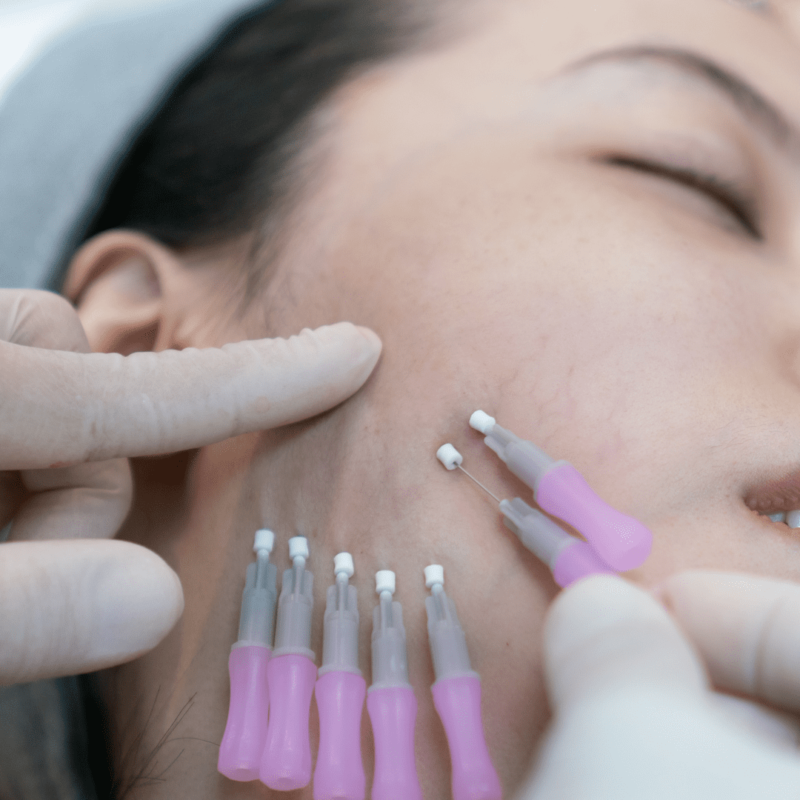 Os Principais Tipos de Lifting Facial e Como Funcionam