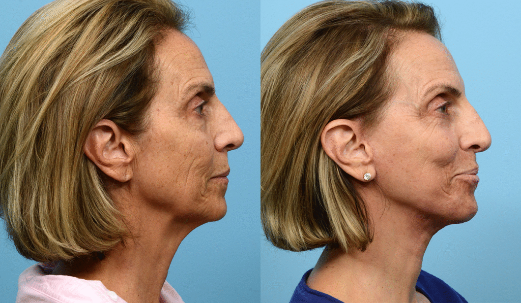 Os Principais Tipos de Lifting Facial e Como Funcionam