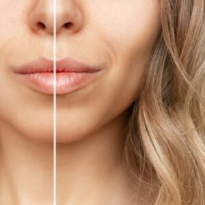 Bichectomia: o que é, para quem serve e o que ninguém te conta antes de operar